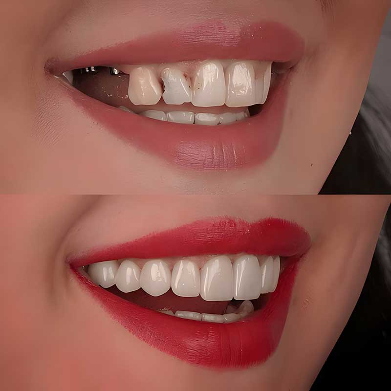 اصلاح طرح لبخند